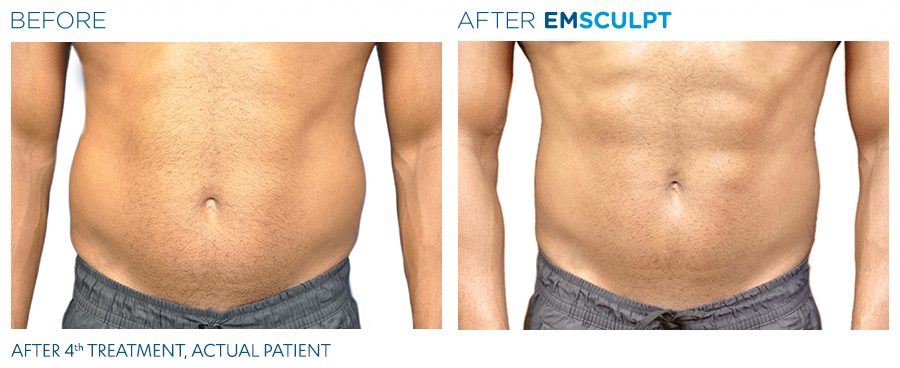 Emsculpt before and after